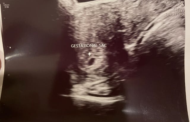 Photo: Bridget Bosco (Used with Permission) image of ultrasound showing gestational sac, no heartbeat