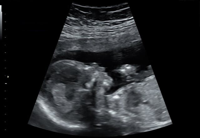 Baby Evans, 16 weeks 2 days (Photo: Savannah Evans) ultrasound of baby at 16 weeks