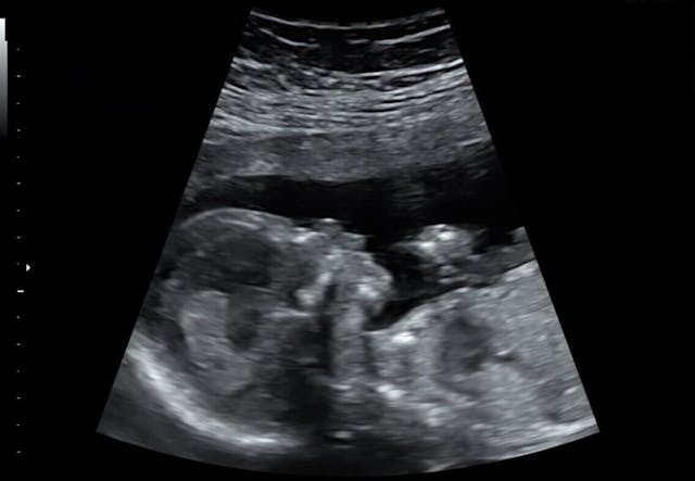 ultrasound of baby at 16 weeks