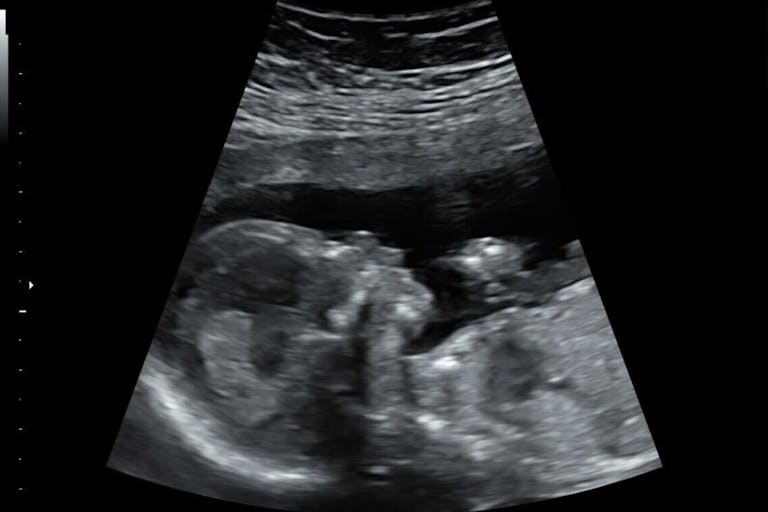 Baby Evans, 16 weeks 2 days (Photo: Savannah Evans) ultrasound of baby at 16 weeks
