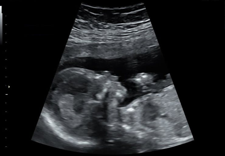 ultrasound of baby at 16 weeks