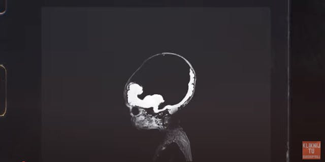 Grupa Proelio A scan of Tomek's brain which lines the skull while the center of his skull is full of fluid.