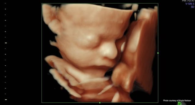 Photo of baby Laurel Rose’s ultrasound (Courtesy of Nielsen family) Family learns ‘God has the final say’ after difficult prenatal diagnosis image