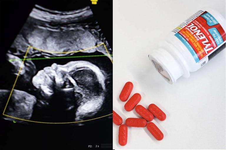 Photos: Getty Images (skaman306; VALERIE MACON/AFP) Split screen of 22-week ultrasound next to photo of Tylenol caplets