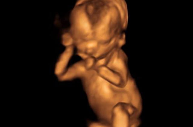 Ultrasound of a preborn baby at 15 weeks gestation