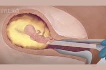 First Trimester D&C Abortion Procedures video A baby is killed via suction D&C abortion in the first trimester.