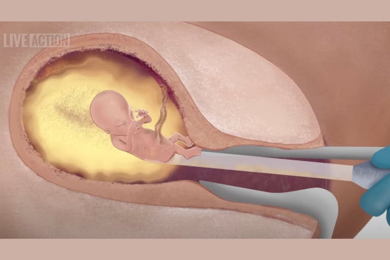 First Trimester D&C Abortion Procedures video A baby is killed via suction D&C abortion in the first trimester.