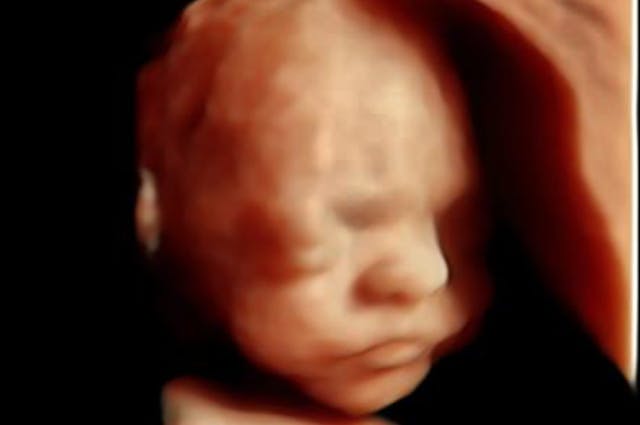 Photo: 24 weeks gestation/4D Ultrasound Lady (Facebook) 24 wks gestation – 4D Ultrasound Lady
