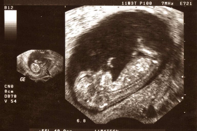 Photo: TwilightEye/Getty Images (11 weeks) Ultrasound female week 11
