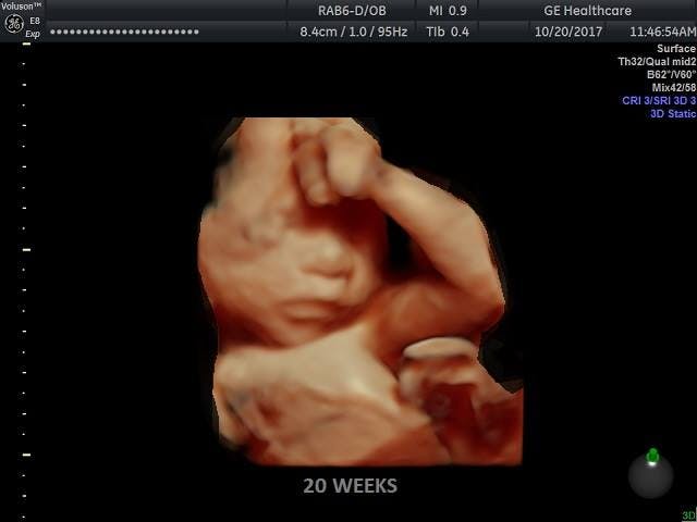Baby at 20 weeks