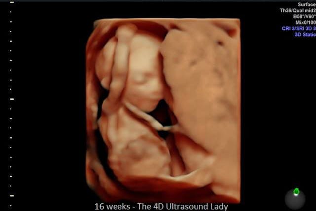 Photo: 4D Ultrasound Lady (Facebook) - 16 weeks gestation abortions, D&E, preborn, how abortion works, pro-life, abortion, Preborn human at about 16 weeks - estimated time of the attempted abortion of Elisa.