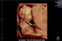 Photo: 4D Ultrasound Lady (Facebook) - 16 weeks gestation abortions, D&E, preborn, how abortion works, pro-life, abortion, Preborn human at about 16 weeks - estimated time of the attempted abortion of Elisa.
