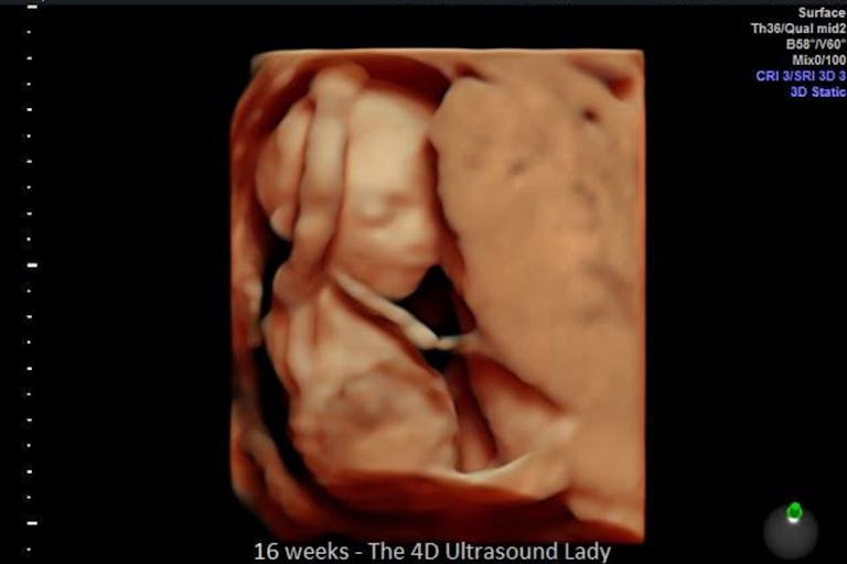 Photo: 4D Ultrasound Lady (Facebook) - 16 weeks gestation abortions, D&E, preborn, how abortion works, pro-life, abortion, Preborn human at about 16 weeks - estimated time of the attempted abortion of Elisa.