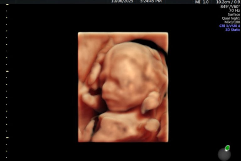 Photo: 4D Ultrasound Lady (Facebook) 18 weeks gestation 18 weeks gestation