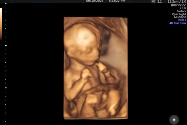 Photo: 4D Ultrasound Lady (Facebook) 18 weeks gestation 18 weeks gestation