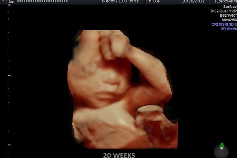 Photo: 4D Ultrasound Lady (Facebook) 20 weeks prolife, miracle, fetus, unborn child, TED