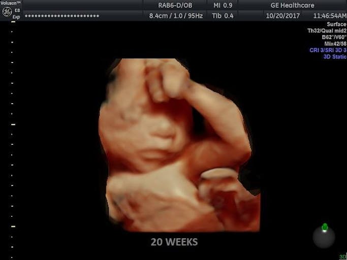 prolife, miracle, fetus, unborn child, TED