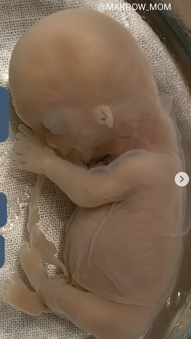 Photo: @MARROW_MOM Instagram Preborn baby Leo who died at 12 weeks in the womb.