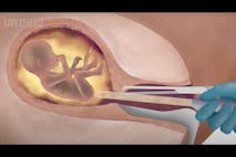 Image shows a computer-animated rendering of a preborn child as an abortionist prepares to commit a dilation and evacuation abortion procedure.