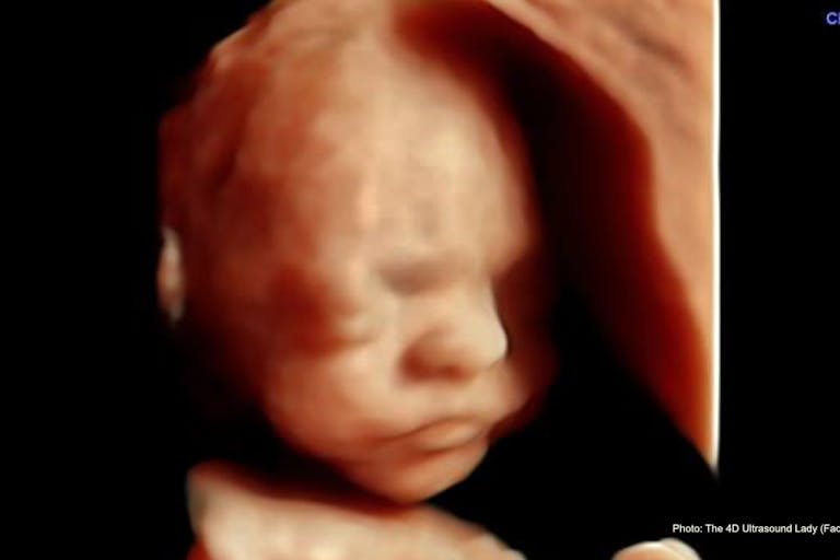 Photo: 4D Ultrasound Lady (Facebook) 24 weeks gestation ultrasound 24 weeks