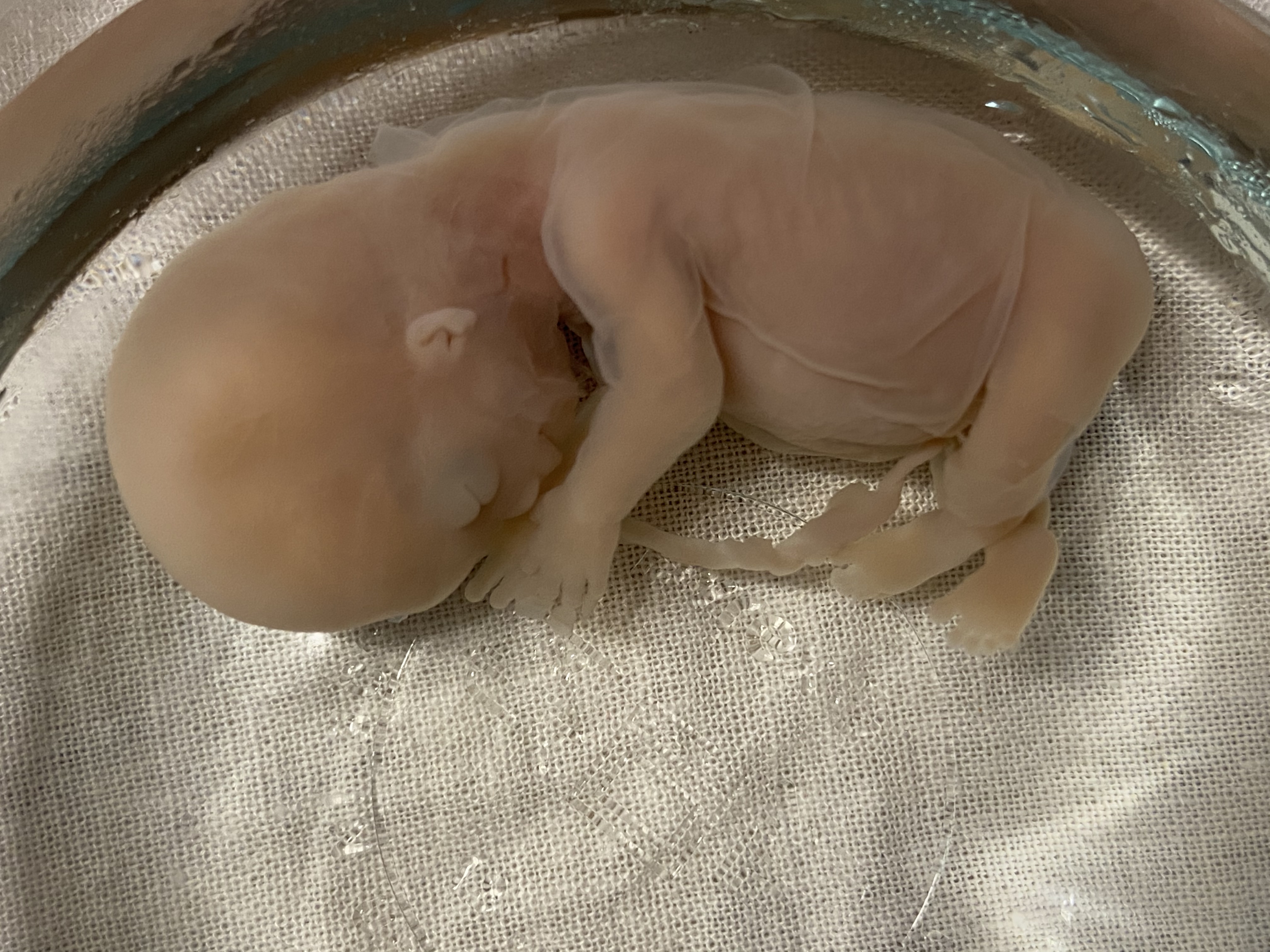 A baby boy named Leo, miscarried at 12 weeks. His fingers, face, toes and ears are all visible.
