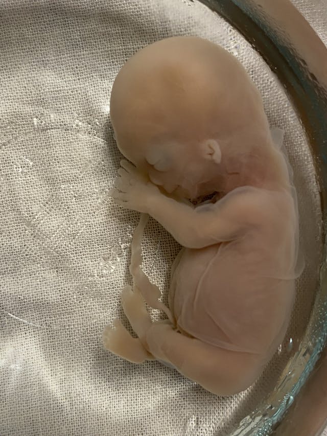 Photo: Baby Leo, miscarried at 12 weeks. Courtesy of the Keller family. A baby boy named Leo, miscarried at 12 weeks. His fingers, face, toes and ears are all visible.