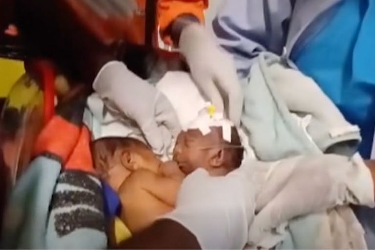 Screenshot: ABC Pacific/Facebook video Conjoined twins in Papua New Guinea.