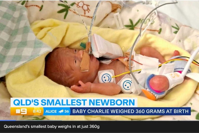 Baby Charlie in his hospital bed shortly after his birth.