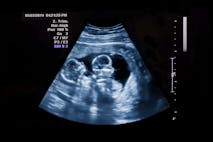Ultrasound of Identical Twins - stock photo