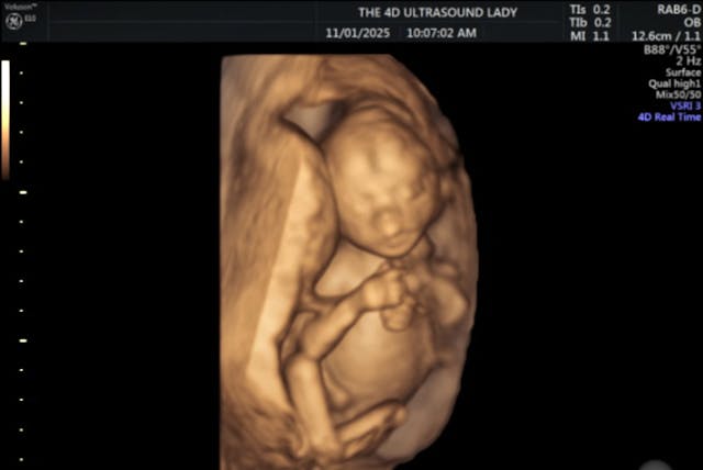 4D ultrasound 18 weeks gestation