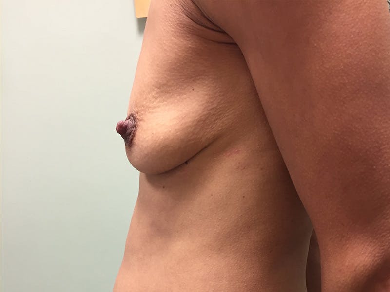 Breast Augmentation Before & After Gallery - Patient 396412 - Image 5