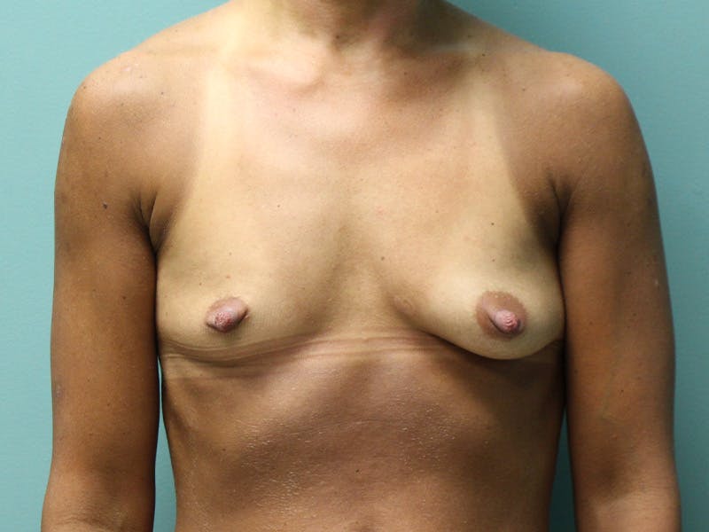 Before and after breast augmentation