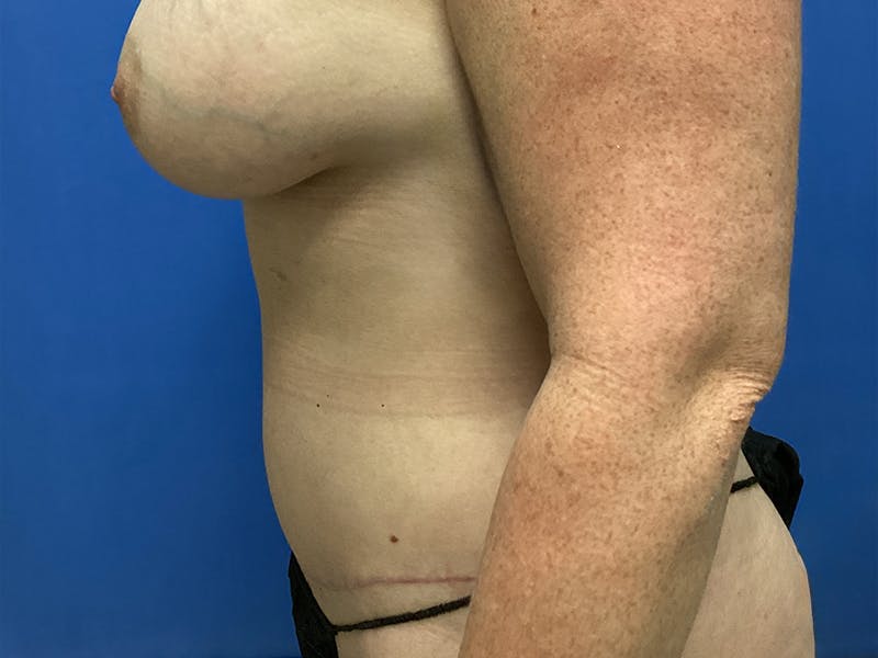 before and after tummy tuck
