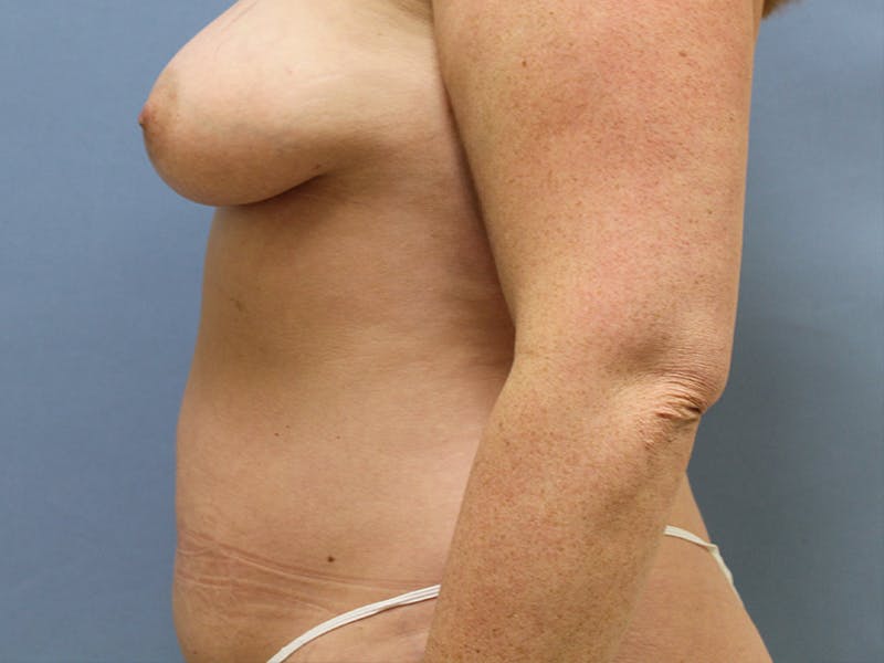 before and after tummy tuck