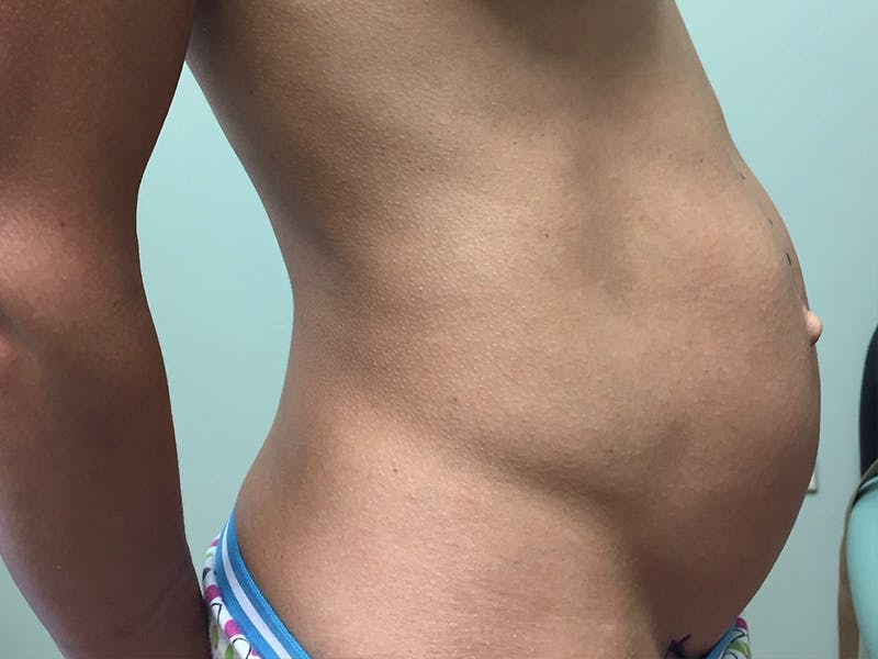 before and after tummy tuck
