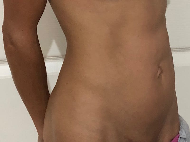 before and after tummy tuck