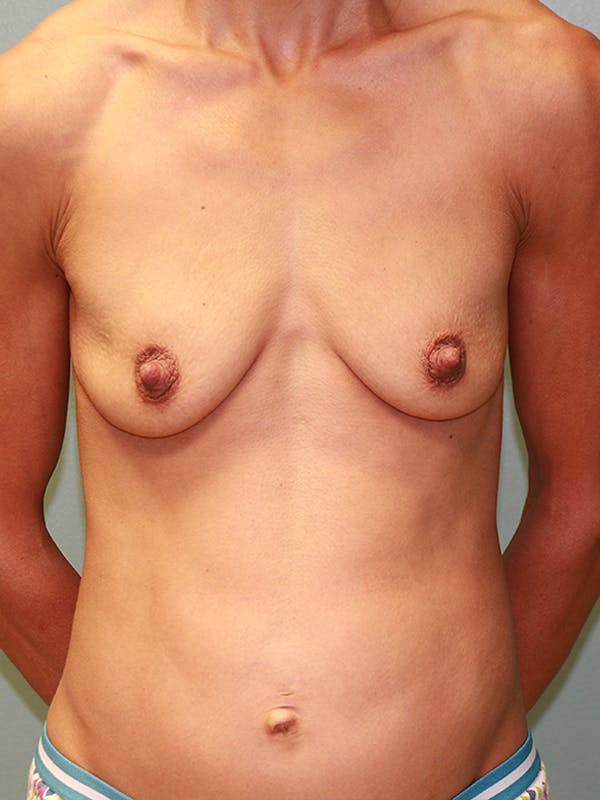 before and after mommy makeover