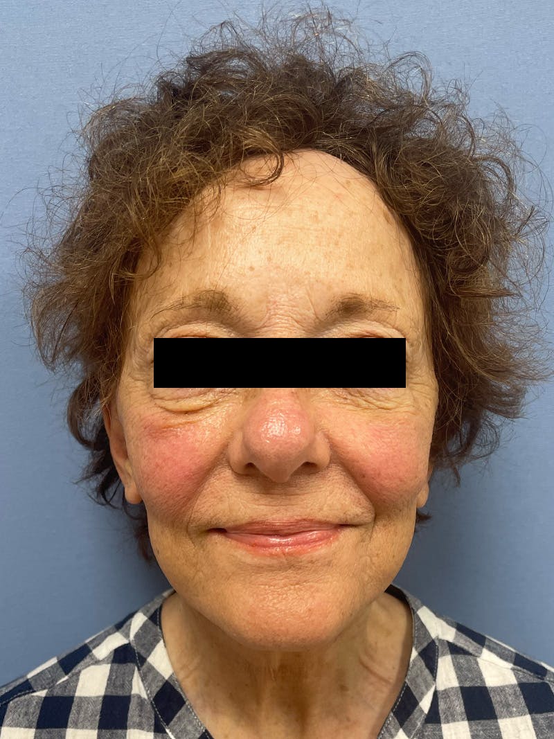 Facelift before and after