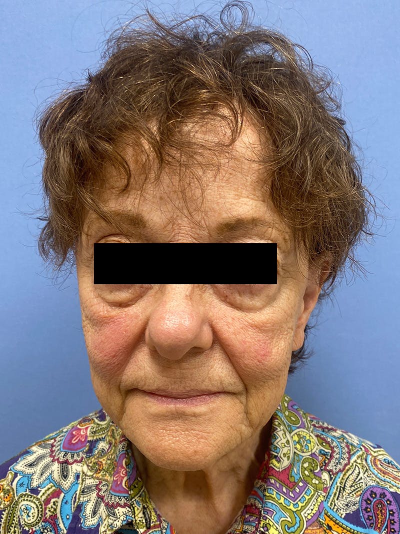 Facelift before and after