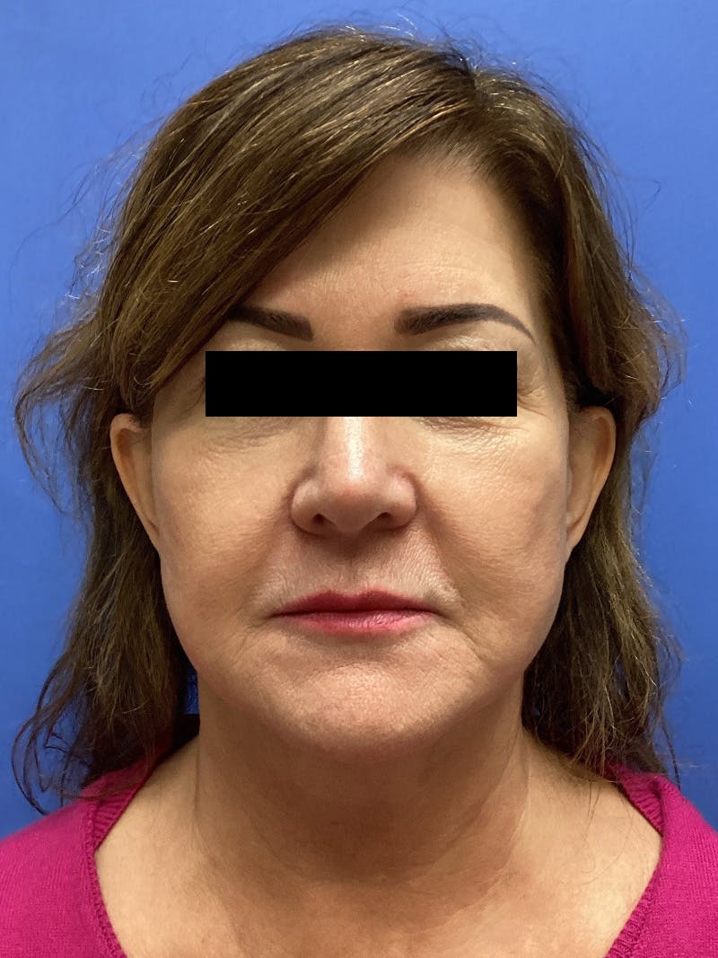 Facelift before and after