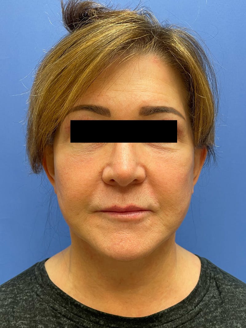 Facelift before and after