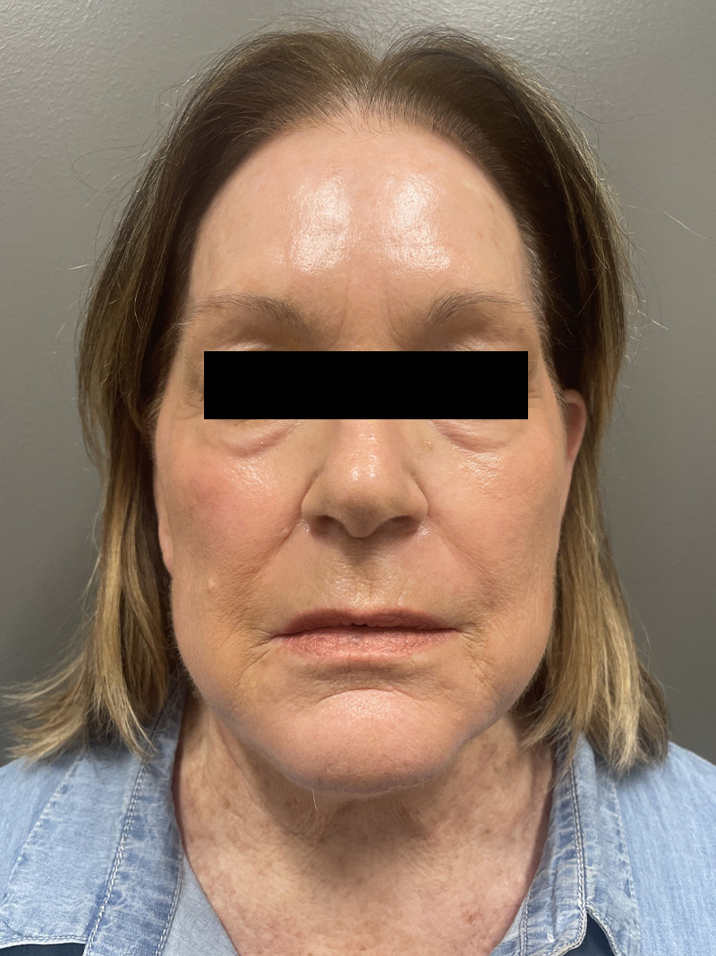 FACELIFT Before & After Gallery - Patient 110393 - Image 1