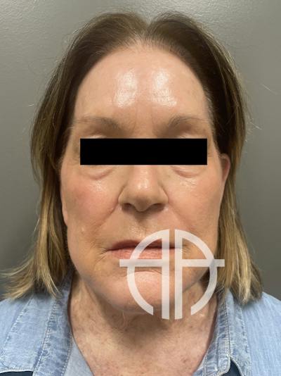 FACELIFT Before & After Gallery - Patient 110393 - Image 1