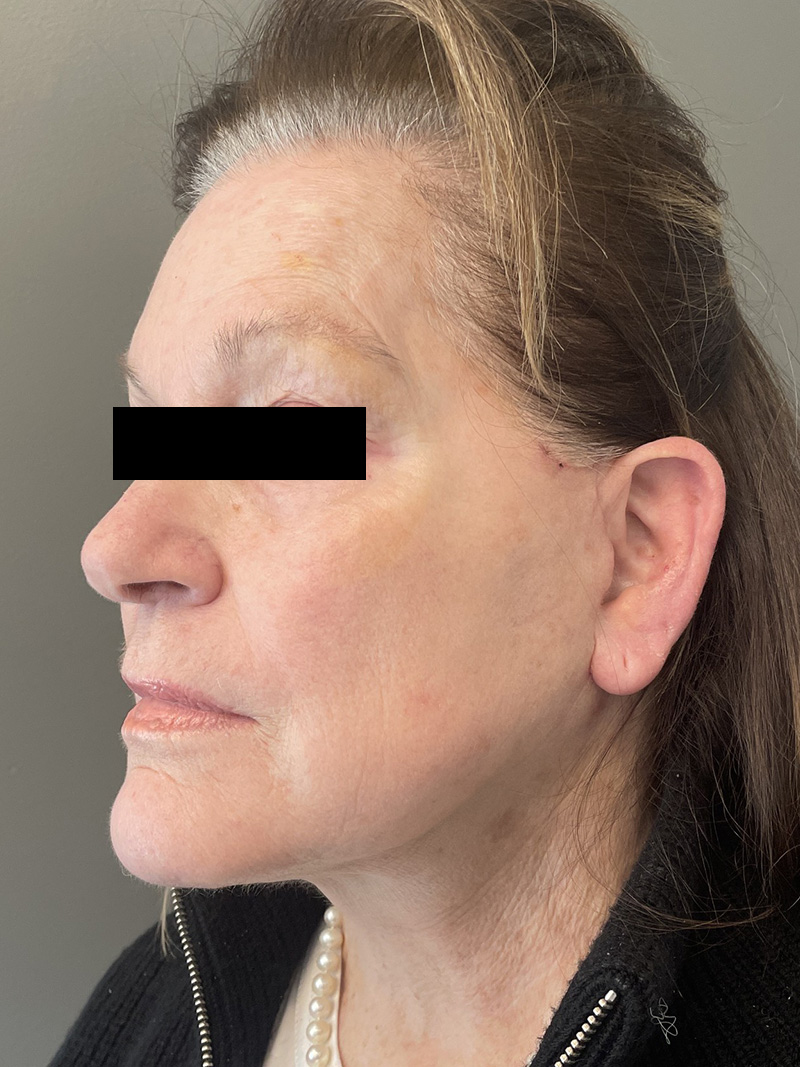 FACELIFT Before & After Gallery - Patient 110393 - Image 8