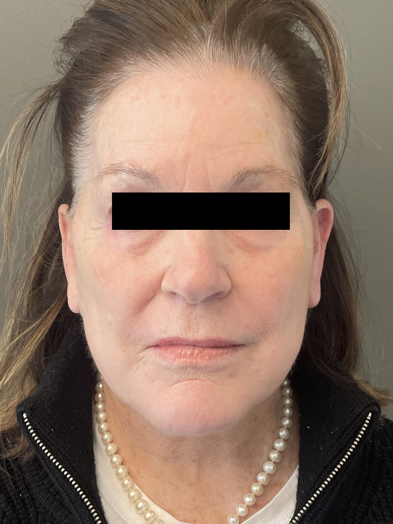 FACELIFT Before & After Gallery - Patient 110393 - Image 2