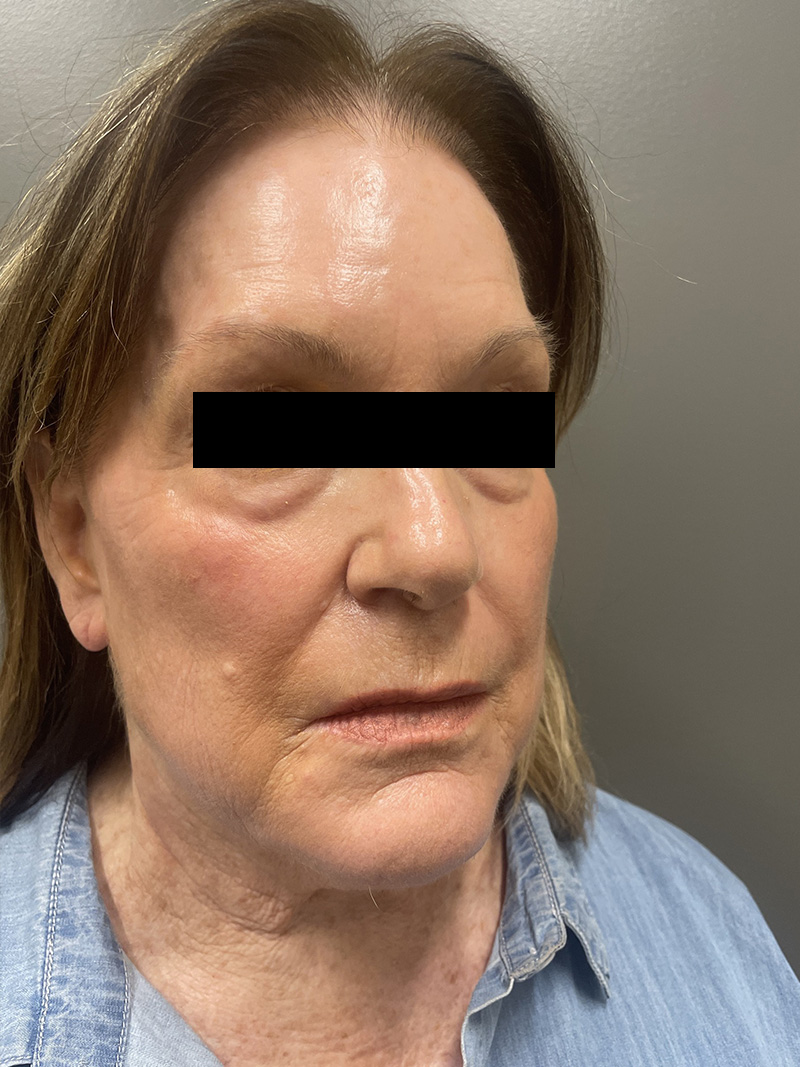 FACELIFT Before & After Gallery - Patient 110393 - Image 3