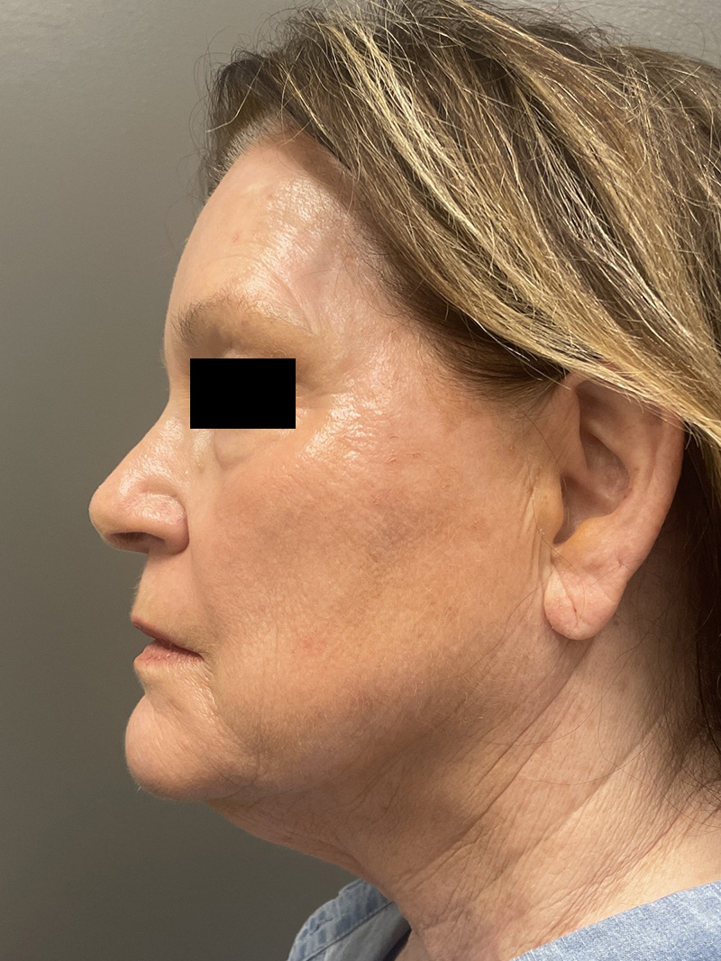 FACELIFT Before & After Gallery - Patient 110393 - Image 5