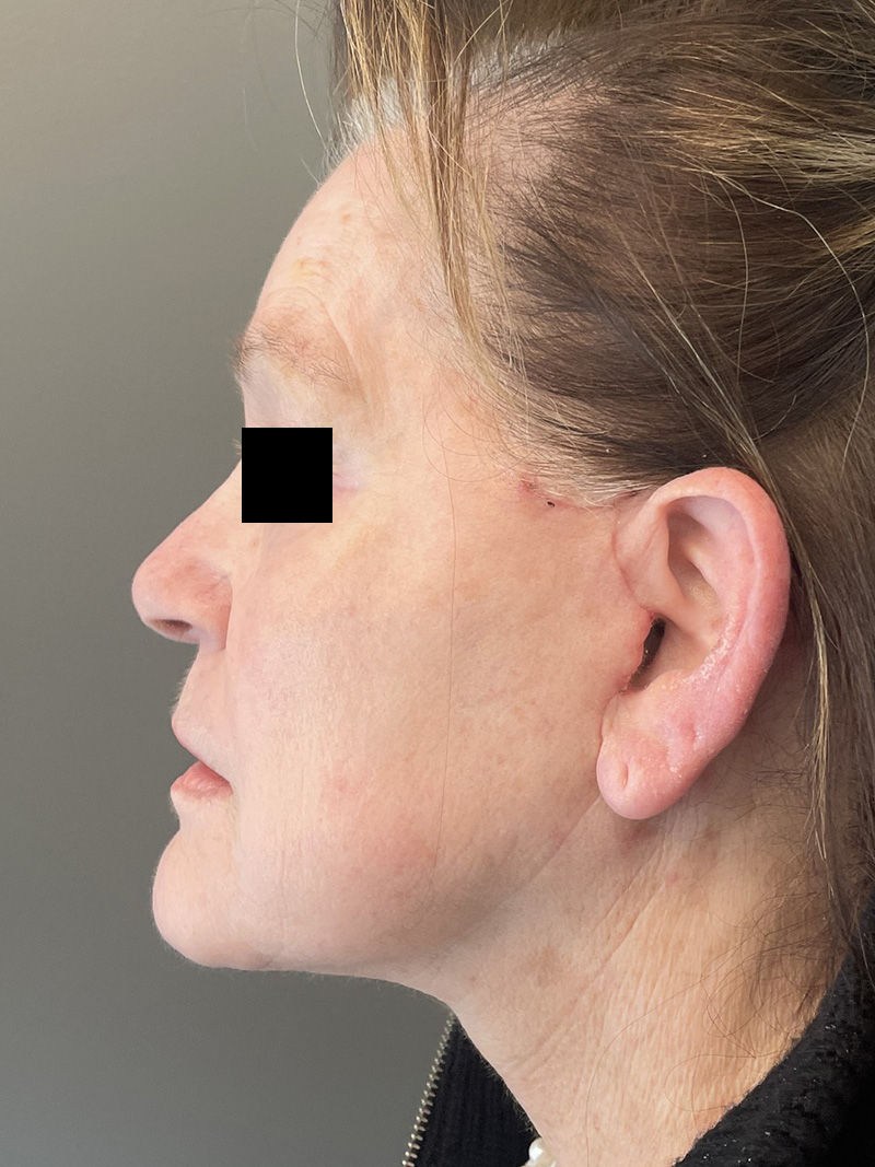 FACELIFT Before & After Gallery - Patient 110393 - Image 6
