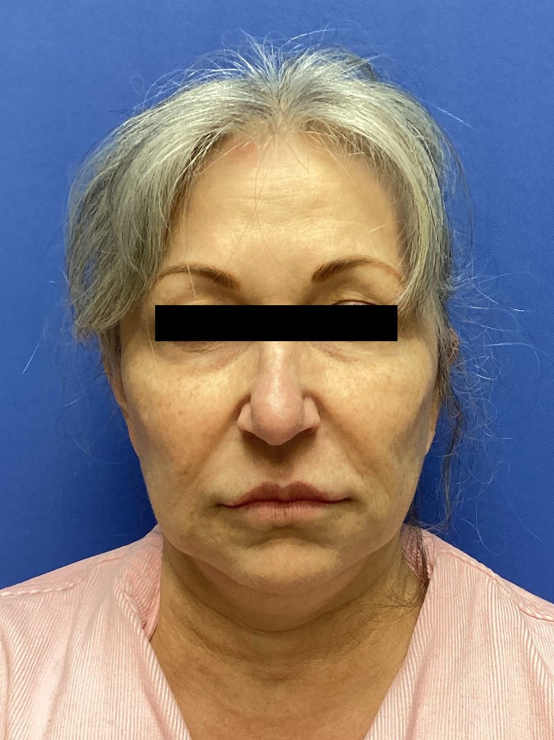 Facelift before and after