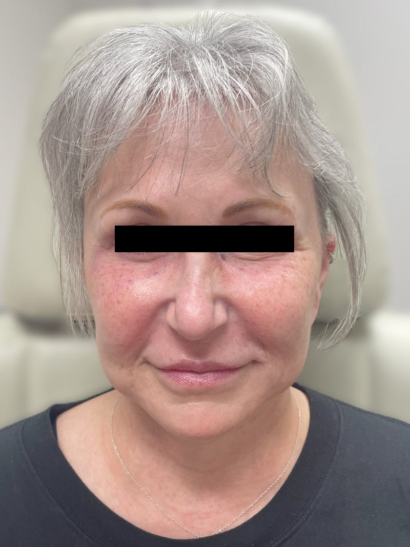 Facelift before and after